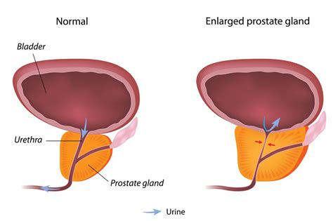 Mildly Enlarged Prostate Gland Prostate Gland Size Chart Shotgnod