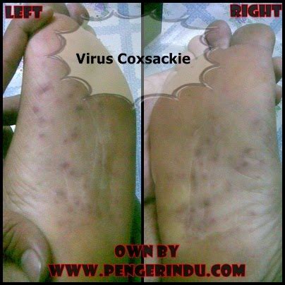 Find out information about coxsackie virus. Lauriegina Portal 2: Penyakit Virus Coxsackie!