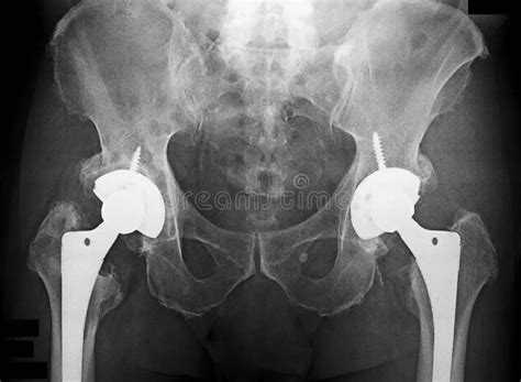 Total Hip Replacement Xray Stock Photos Free And Royalty Free Stock