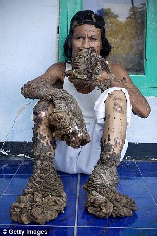 Traffic guys are broken after night road accident. Indonesian known as 'the tree man' due to disease dies ...