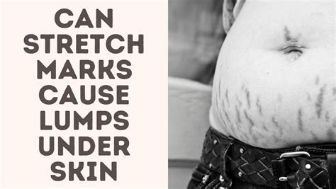 Can Stretch Marks Cause Lumps Under Skin Treat Your Scars