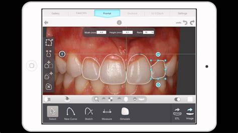 Digital Smile Design New Approach To Cosmetic Dentistry