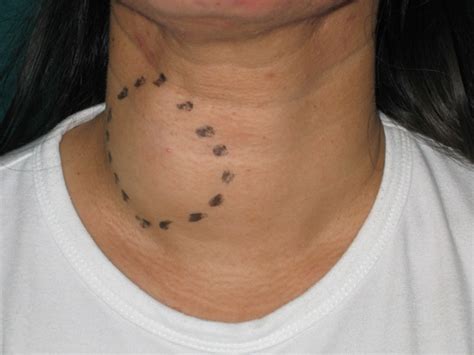 Itching As Related To Colloid Nodular Goiter Pictures