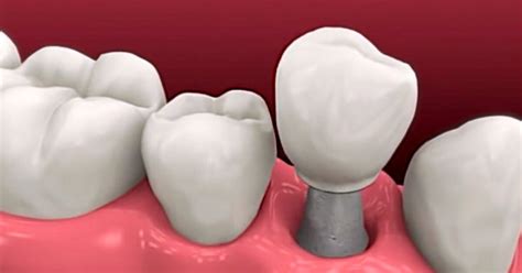 Dental Implants Rochester Ny Progressive Implantology And Periodontics