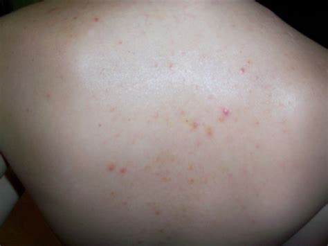 What Causes Itchy Rash All Over Body New Health Advisor
