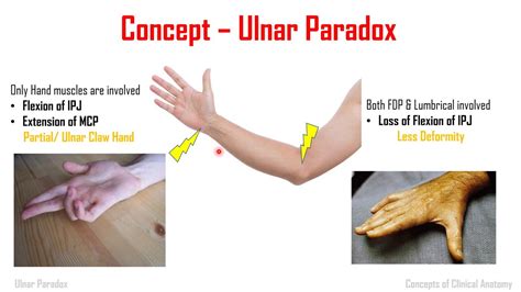 Anatomical Basis Of Ulnar Paradox Youtube