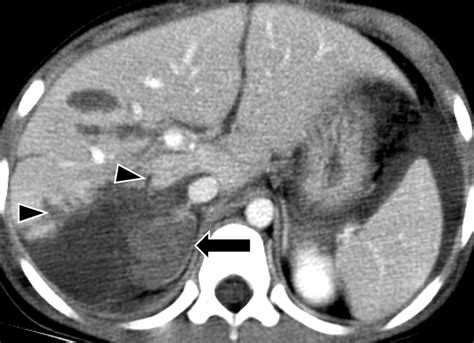 CT In Blunt Liver Trauma RadioGraphics