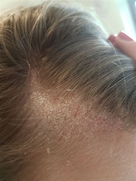 Lost In The Oyster Scalp Eczema