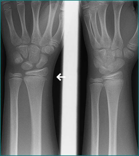 Is There A Spilled Teacup On This 4 View Wrist X Ray To Suggest A