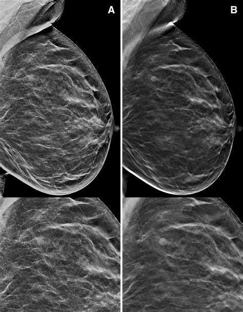 Digital Breast Tomosynthesis And Synthetic 2d Mammography Versus