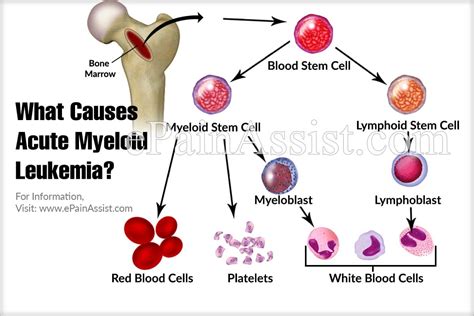 Acute Myeloid Leukemia Causes