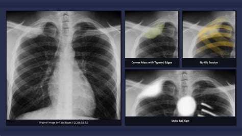 Marfan Syndrome Chest X Ray