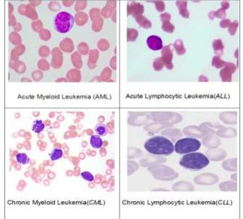 Kinds Of Leukemia Download Scientific Diagram