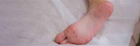 Child Foot With Red Itchy Rash Closeup Stock Photo Image Of
