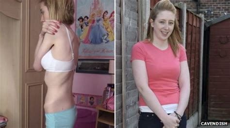 Former Anorexia Sufferer Airbrushing Should Be Banned Bbc News