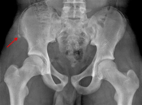 Pelvic Avulsion Fracture