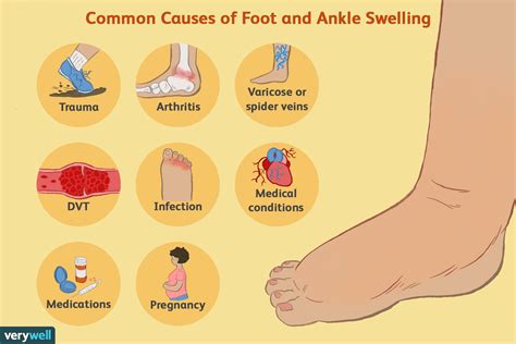 Exercises That Help Reduce Inflammation And Edema Swelling Swellnomore