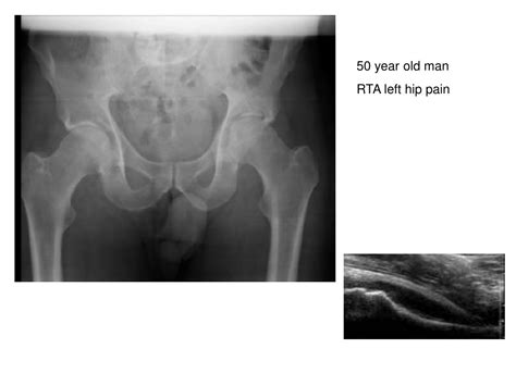 The Different Types Of Hip Fractures Health News Website