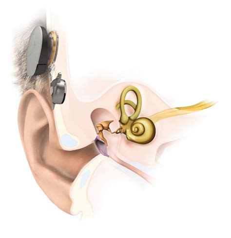 What Different Types Of Cochlear Implants Are There