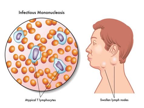 People who get symptoms from ebv infection, usually teenagers or adults, get better in two to four weeks. symptômes de la mononucléose infectieuse — Image ...