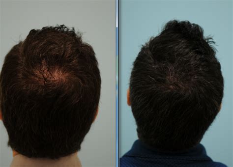 Early signs of teen hair loss when you suffer from hair loss, your chances of stopping and reversing it are significantly improved the sooner you begin treatment. The Young Man Losing Hair: An Update on Current Strategies ...