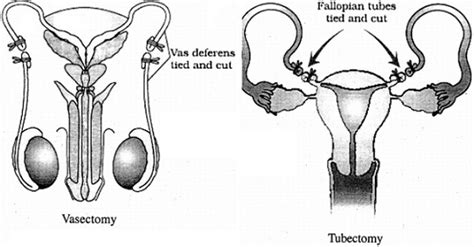 represent diagrammatically the sterilization method vasectomy in male reproductive system and
