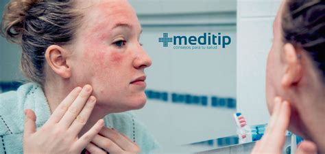 Dermatitis Tipos Causas Y Complicaciones Meditip