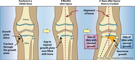 Growth Plate Fracture Or Injury International Center For Limb Lengthening