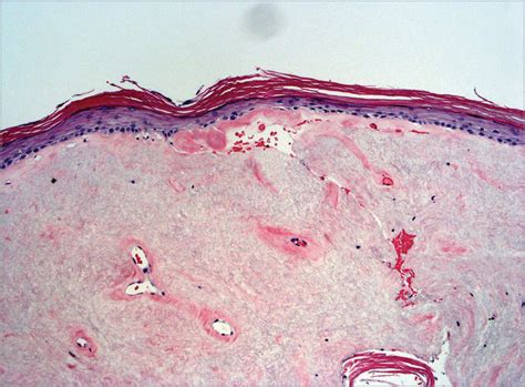 Lichen Sclerosus With Vaginal Involvement Dermatology Jama