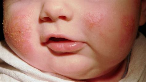 Fast Five Quiz Pediatric Atopic Dermatitis