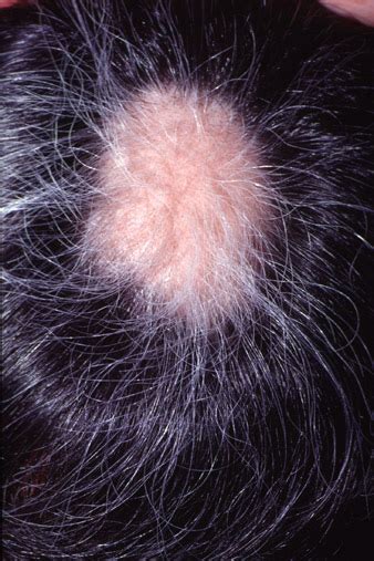 It can be the result of heredity, hormonal changes, medical conditions or a normal part of aging. Circumscript Alopecia areata (AA)