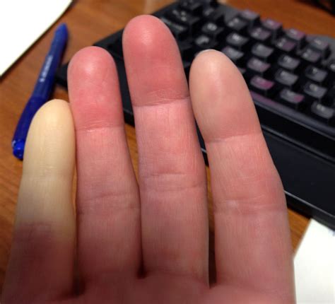 Raynauds Phenomenon The Mystery Of The White Finger At The Waters Edge