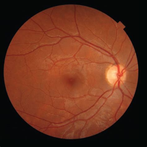 Fundus Photograph Of The Right Eye A Revealed Normal Fundus