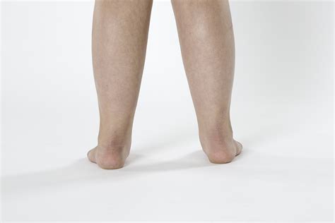 Flat Feet In Kids Problems Causes And Treatment Surestep