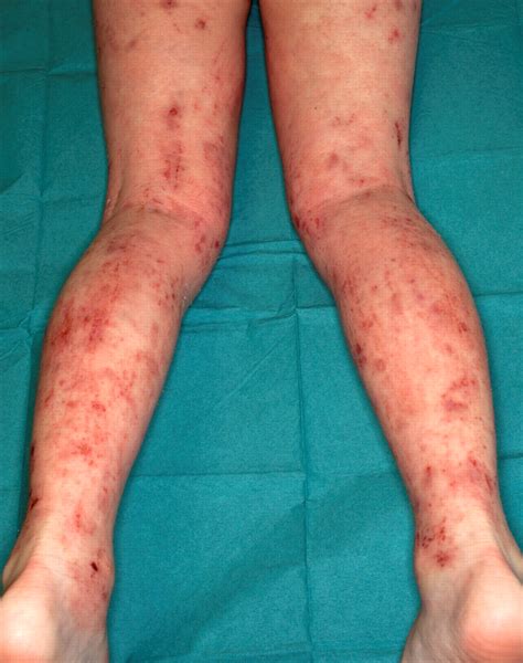 Management Of Difficult And Severe Eczema In Childhood The Bmj