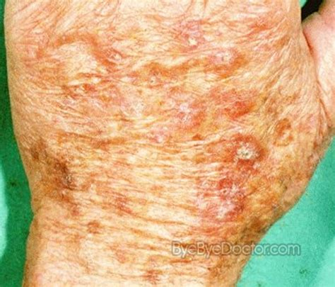 Actinic Keratosis Pictures Symptoms Causes Treatment And Prevention