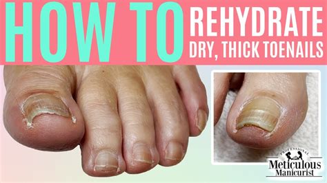 👣how To Rehydrate A Dry Thick Toenail👣 Youtube