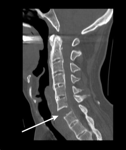 Cervical Spine Fracture In Ankylosing Spondylitis The Western Journal