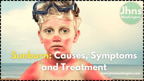 Sunburn Causes Symptoms And Treatment