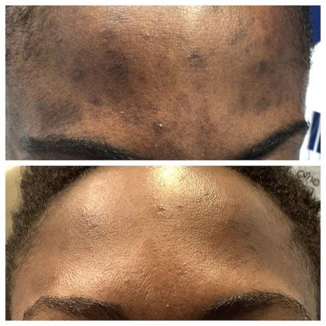 African American Hyperpigmentation Before And After St Louis