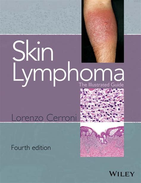 Skin Lymphoma The Illustrated Guide 4ed Coop Zone