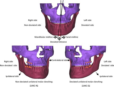 Frontal View Of A Preoperative Patient With Mandibular Deviation To The