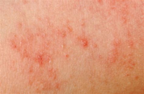 Rash Due To Dry Skin