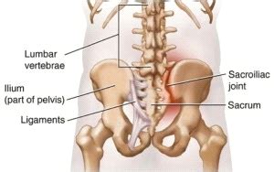 Sacroiliac Joint Dysfunction Treatment In Sydney Podiatry First