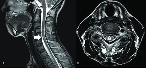 Sagittal A And Axial B T2 Weighted Magnetic Resonance Imaging Of