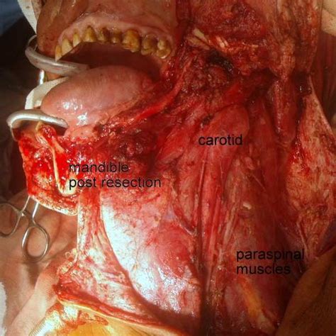 Neck Dissection Showing Left Level Ii Lymph Node Adherent To Ijv