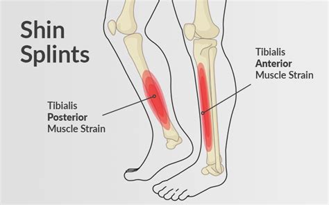 Shin Splints Causes Treatment Recovery And Prevention Myofitness