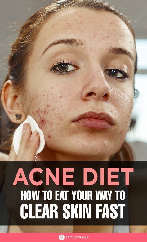 Skin Care Acne Skin Care Tips Acne Reasons Clear Skin Fast How To