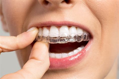 Invisible Braces Clear Braces From Invisalign To Straighten Teeth