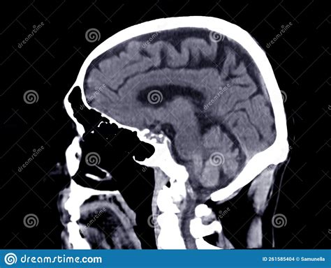 Ct Scan Of The Brain Sagittal View For Diagnosis Brain Tumorstroke